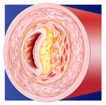Artery Cholesterol crossection1